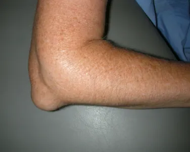 Elbow Bursitis