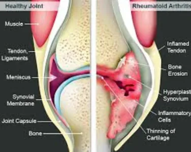 Rheumatoid Arthritis