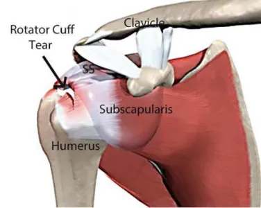 Rotator Cuff Injuries