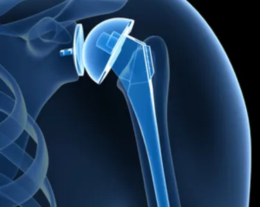 Shoulder Replacement