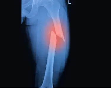 A Team of doctors is performing Robotic Knee Surgery