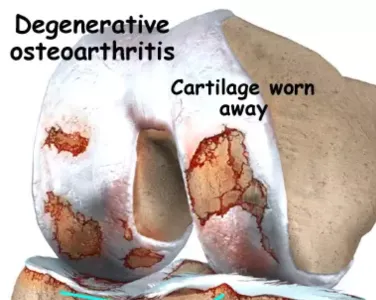 A Team of doctors is performing Robotic Knee Surgery