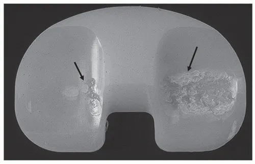 A Team of doctors is performing Robotic Knee Surgery